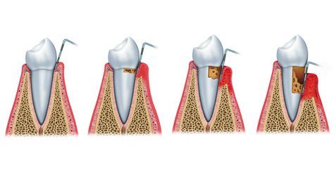 Parodontitis / Parodontose
